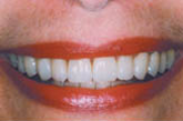 After Teeth Whitening