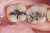 Before White Fillings