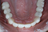 Crown and bridge procedure after