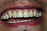Veneer After